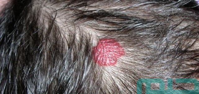 تفسير حلم بقع حمراء في الرأس