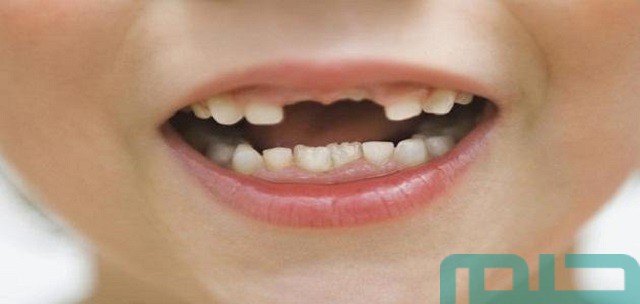 تفسير حلم تساقط الاسنان في المنام تفسير حلم تساقط الاسنان في المنام