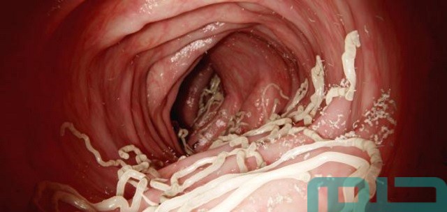 تفسير حلم خروج الدود من الأنف تفسير حلم خروج الدود من الأنف