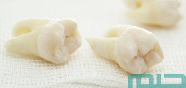 تفسير حلم خلع الضرس