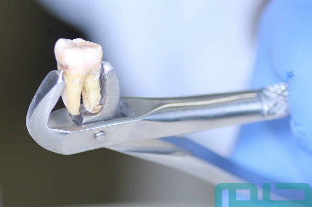 تفسير حلم خلع ضرس شخص آخر