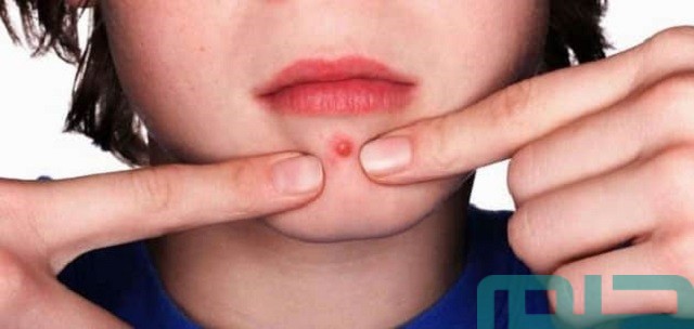 تفسير حلم رؤية الدمامل