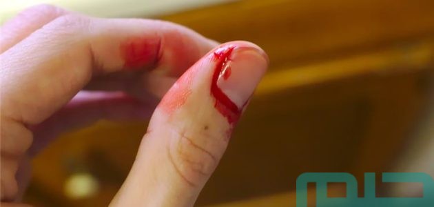 تفسير حلم رؤية جرح اليد والجسم في المنام ودلالاته وبشرياته 1 تفسير حلم رؤية جرح اليد