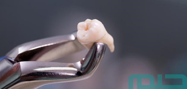 تفسير حلم سقوط الضرس العلوي