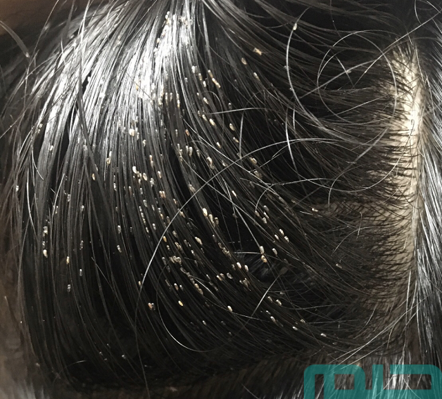 تفسير حلم سقوط القمل من الشعر تفسير حلم سقوط القمل من الشعر