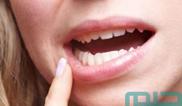 سبب تكرار حلم سقوط الأسنان