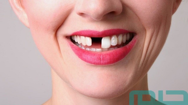 سقوط الأسنان في المنام