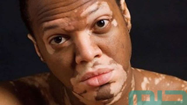 ما تفسير حلم البهاق في الوجه للمتزوجة؟ ما تفسير حلم البهاق في الوجه للمتزوجة؟