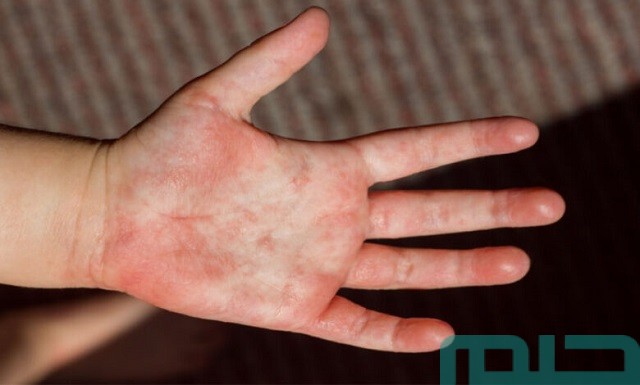 ما تفسير حلم الحبوب في الذراعين؟