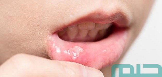 ما تفسير حلم الحبوب في الشفايف؟ ما تفسير حلم الحبوب في الشفايف؟