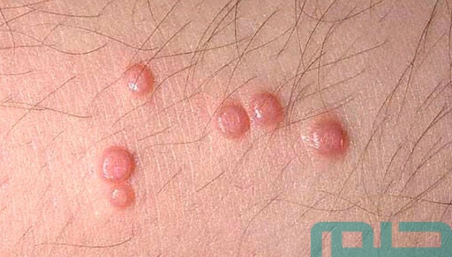 تفسير حلم رؤية الحبوب في الفخذ في المنام وعلاقته بتحسن الأحوال 2 ما تفسير حلم الحبوب في الفخذ؟