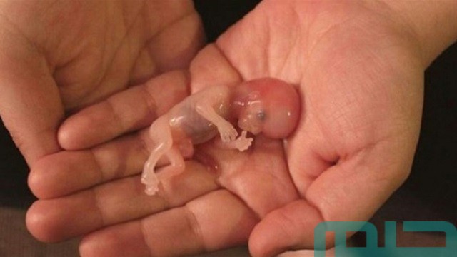 ما تفسير رؤية دم الإجهاض في المنام؟