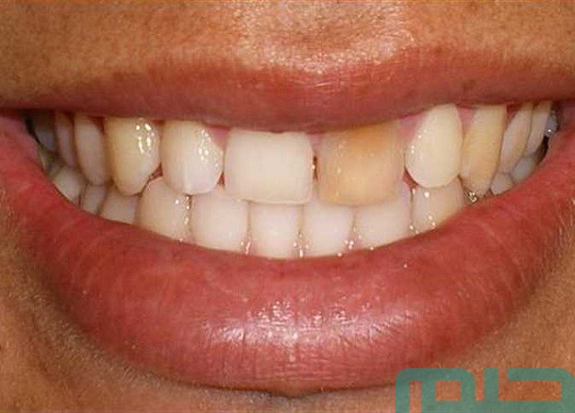 تفسير حلم رؤية الم الاسنان في المنام