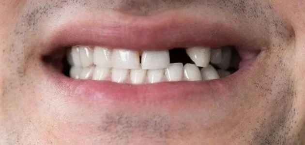 تفسير حلم رؤية الم الاسنان في المنام وعلاقته بالسعادة 1 تفسير حلم رؤية الم الاسنان في المنام