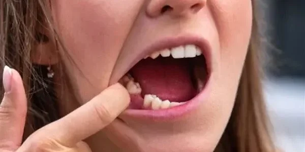 تفسير حلم رؤية خلع الاسنان في المنام وعلاقتها بالمنصب 1 ما تفسير حلم خلع الاسنان في المنام